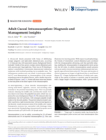 Adult Caecal Intussusception: Diagnosis and Management Insights
