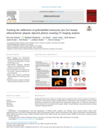 Tracking the infiltration of gold-labelled monocytes into live human atherosclerotic plaques: Spectral photon counting CT imaging analysis